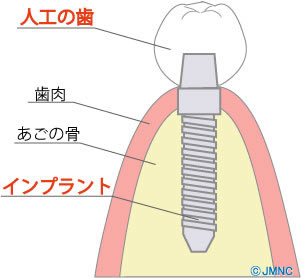 鹿児島　歯医者　インプラントはケアが大切！！