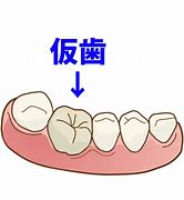 鹿児島　歯医者　つけっぱなしの仮歯