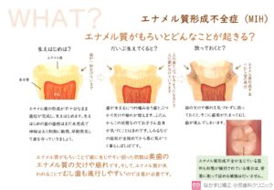 鹿児島　歯医者　エナメル質