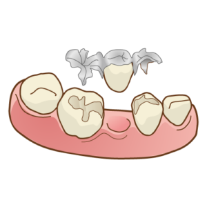 鹿児島　歯医者　詰め物、被せ物