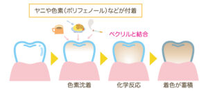 鹿児島　歯医者　ヤニや色素（ポリフェノール）などが付着