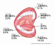 鹿児島　歯医者　お口の粘膜の病気は気づきにくい