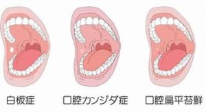 鹿児島　歯医者　口腔粘膜の疾患