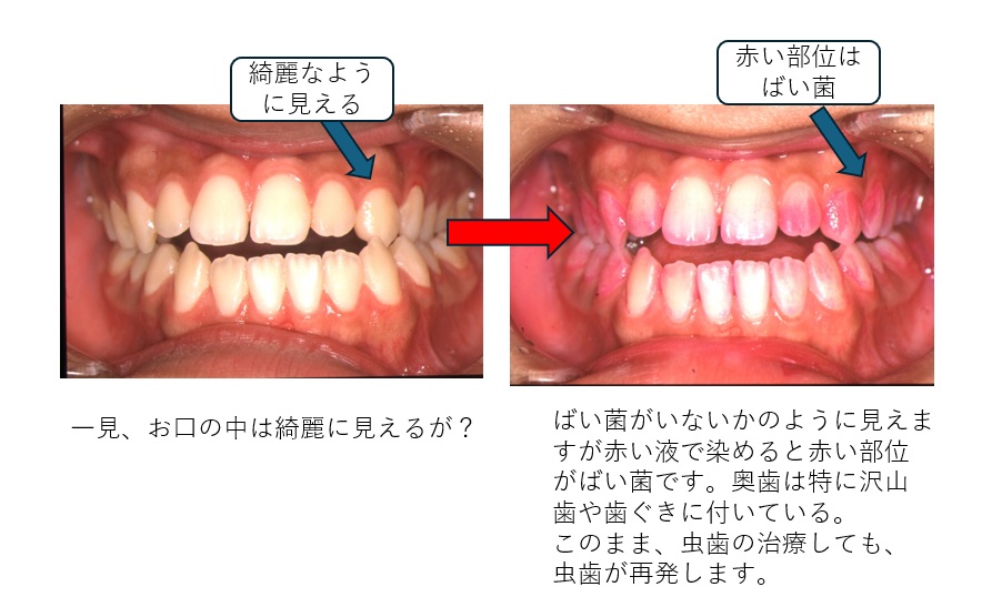 虫歯、再発、ばい菌