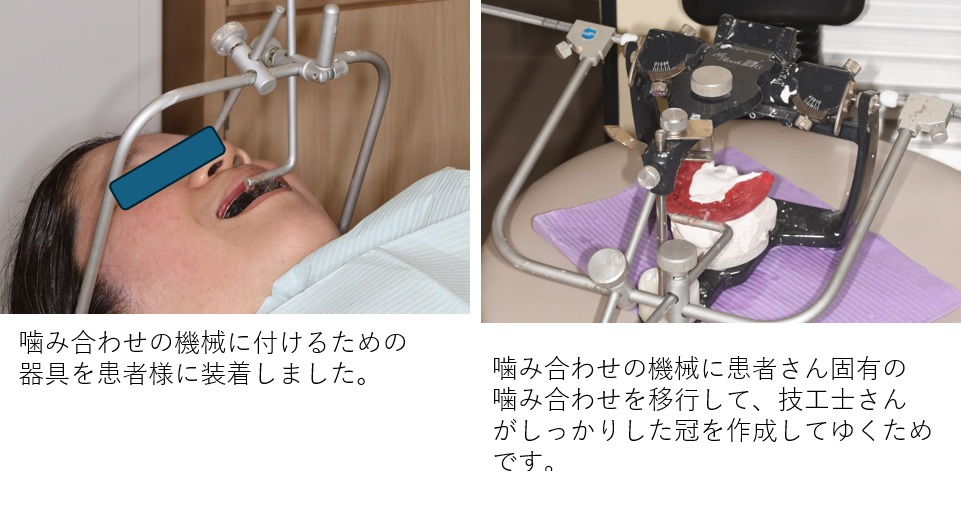フェイスボー　型どり