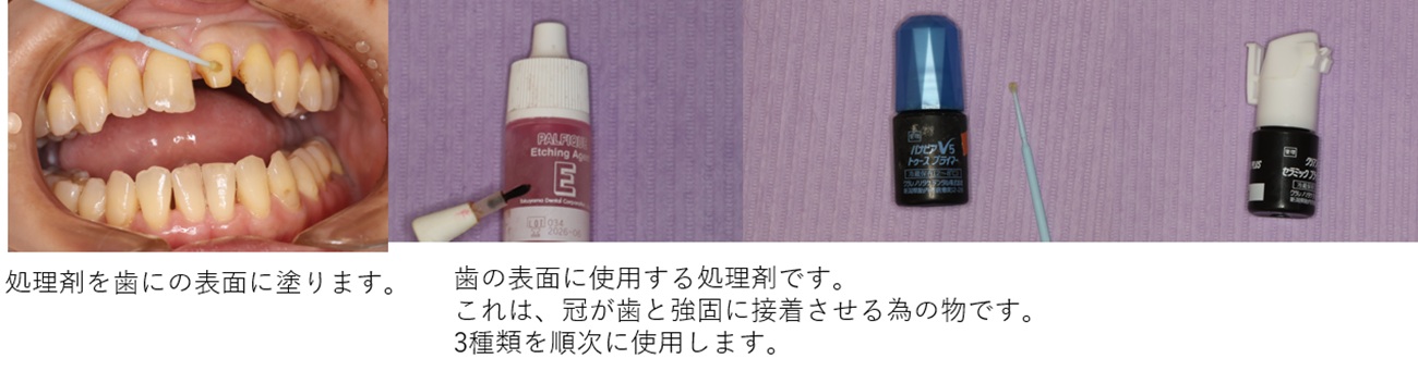 歯、処理剤