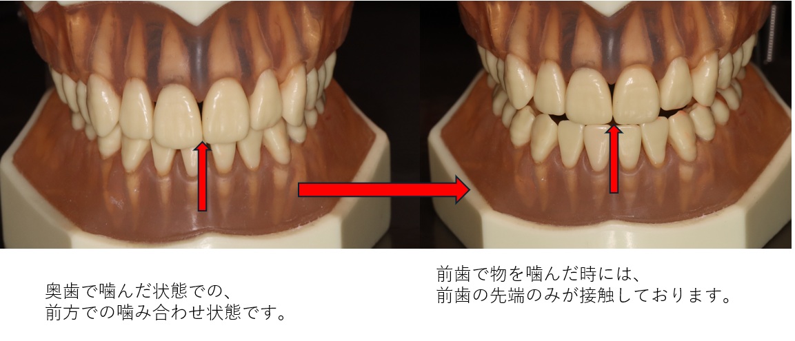 鹿児島　歯医者　噛み合わせ、前歯、ガイド