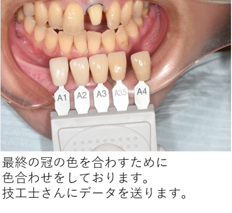 鹿児島　歯医者　色合わせ、シェードガイド