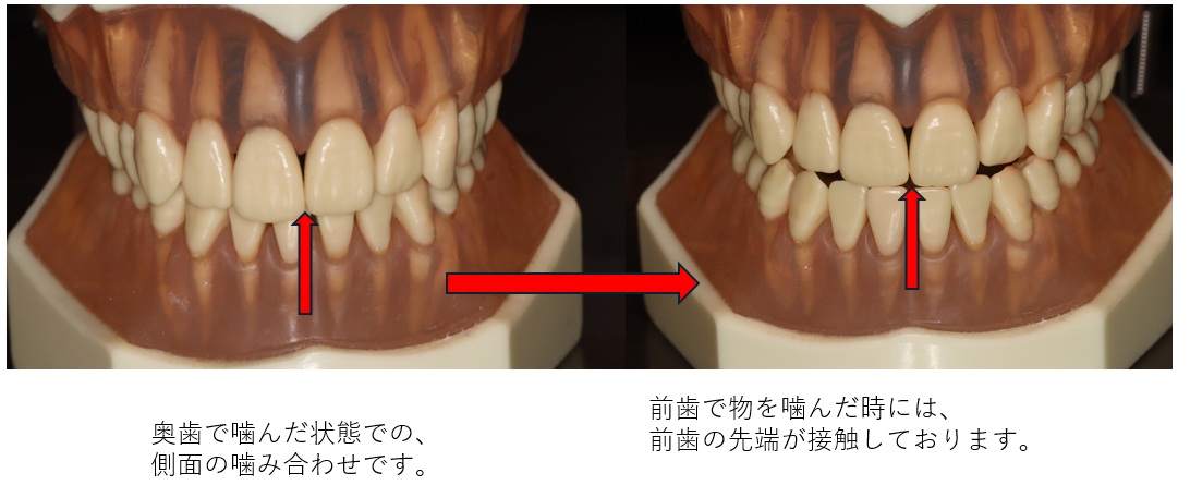 鹿児島 歯医者 前歯ガイド 正面