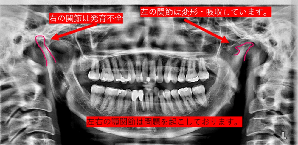 顎関節の変形