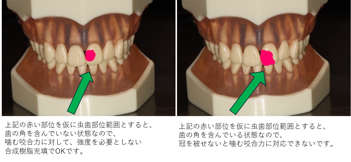 前歯カケ　基準
