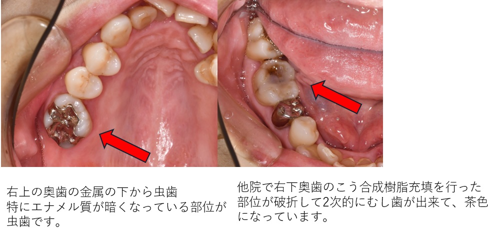 鹿児島　歯医者　虫歯、セラミックインレーを