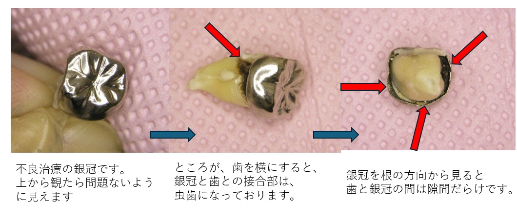 不良治療の冠