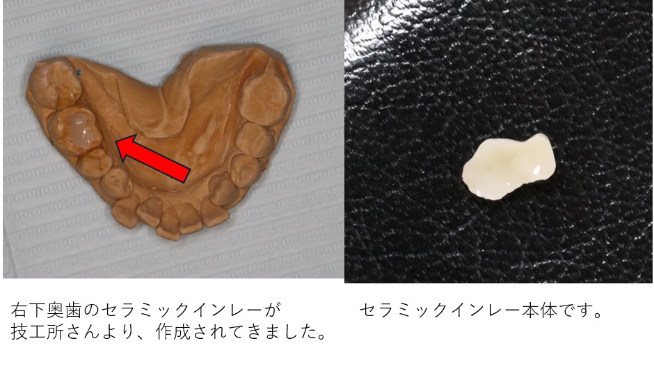 鹿児島　歯医者　虫歯、セラミックインレー