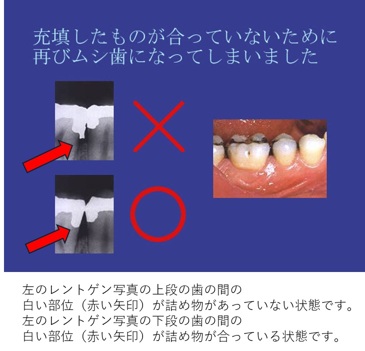詰め物があっていない