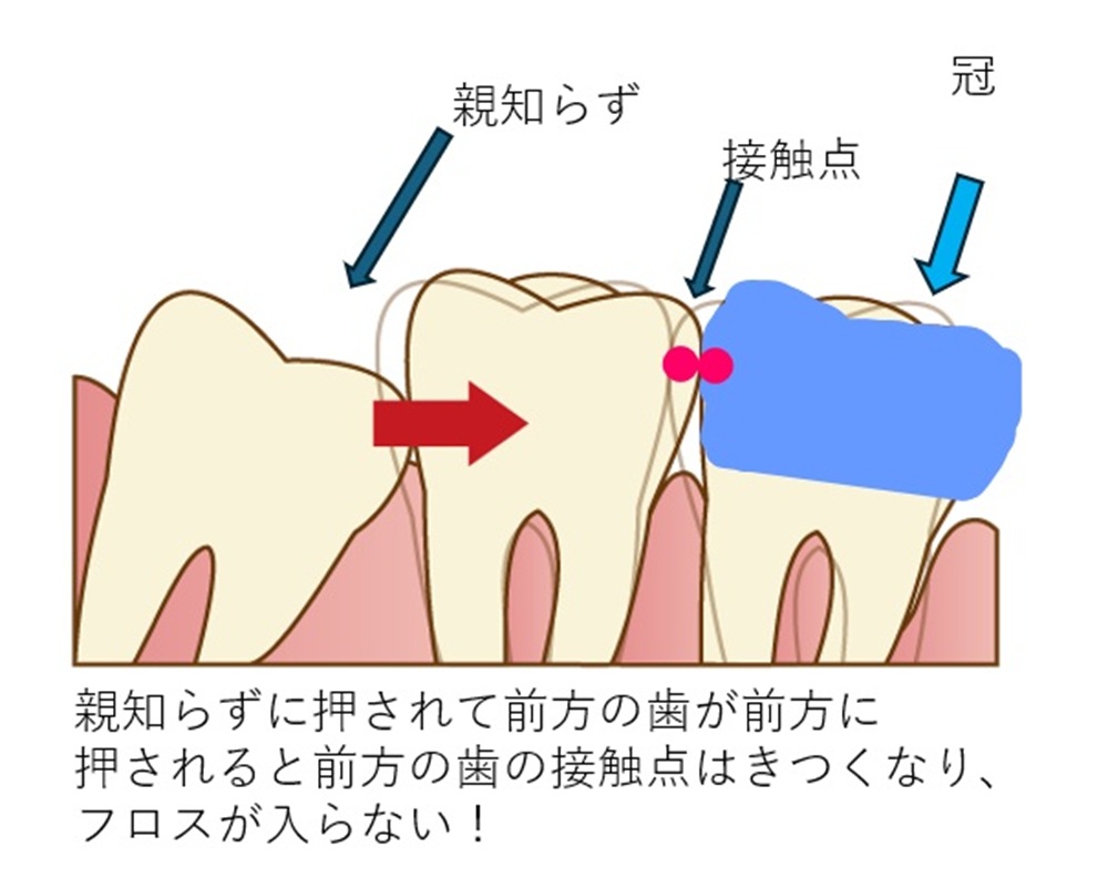 噛み合わせ