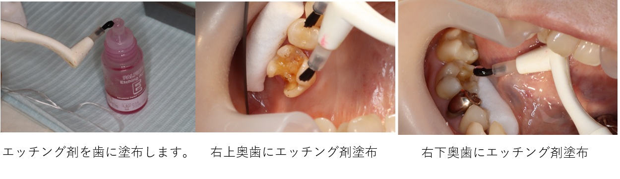 鹿児島　歯医者　エッチング剤　歯