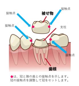 冠、詰め物、接触点