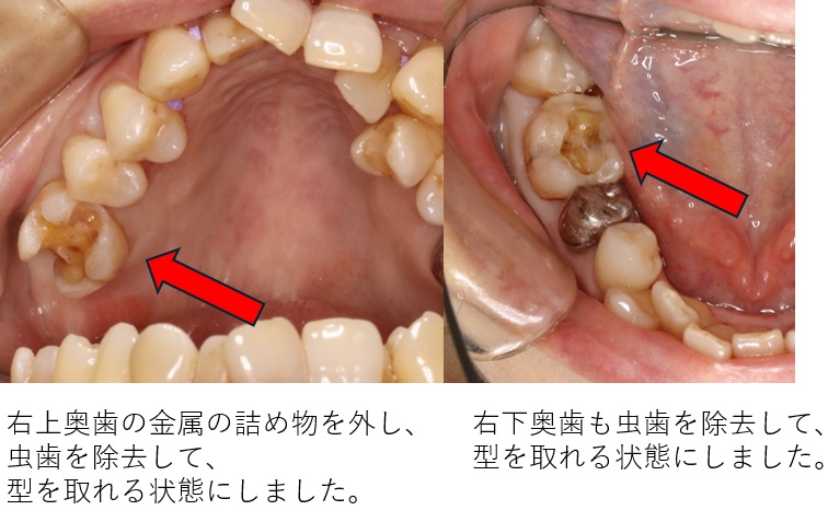 鹿児島　歯医者　型取り、セラミックインレー