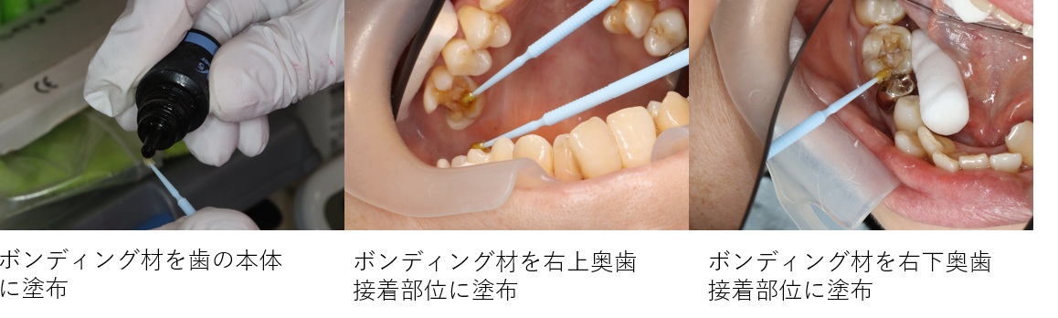 鹿児島　歯医者　ボンディング材　セラミックインレー