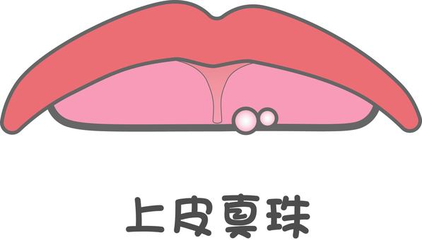 鹿児島　歯医者　上皮真珠