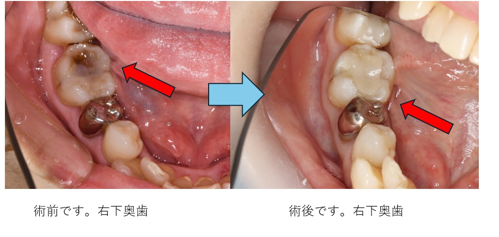 術後、セラミックインレー