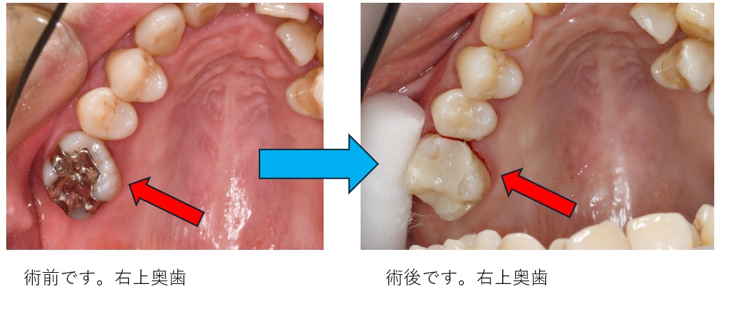 セラミックインレー