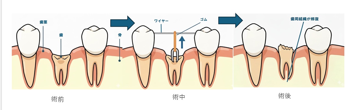 鹿児島 歯医者 エクスルージョン方法 破折