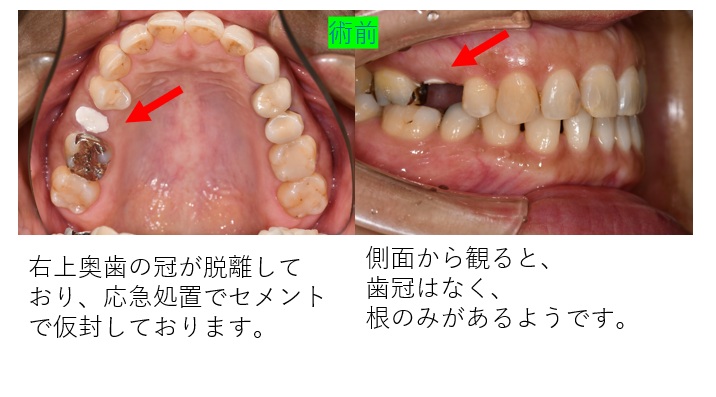 鹿児島 歯医者 歯の破折