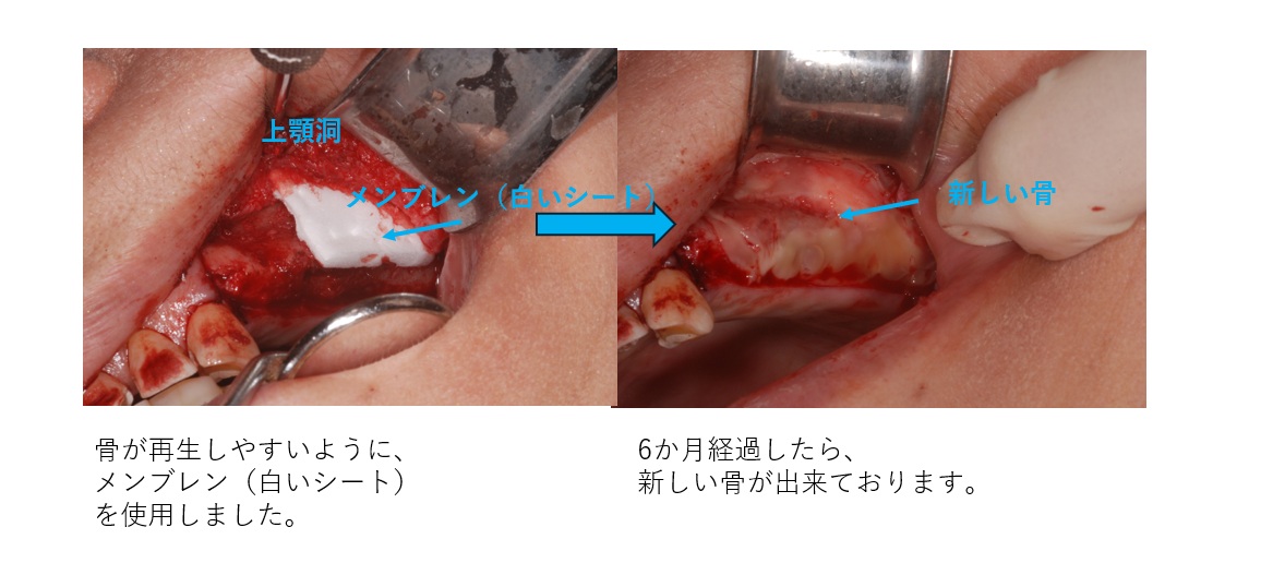 鹿児島　歯医者　インプラント難症例