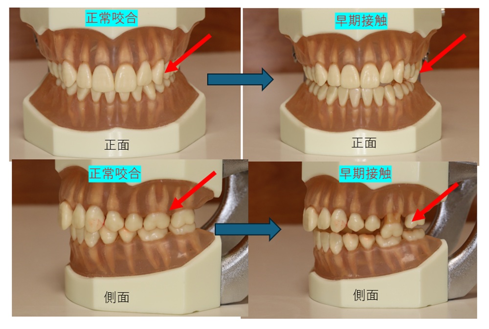 鹿児島 歯医者 噛み合わせ 早期接触