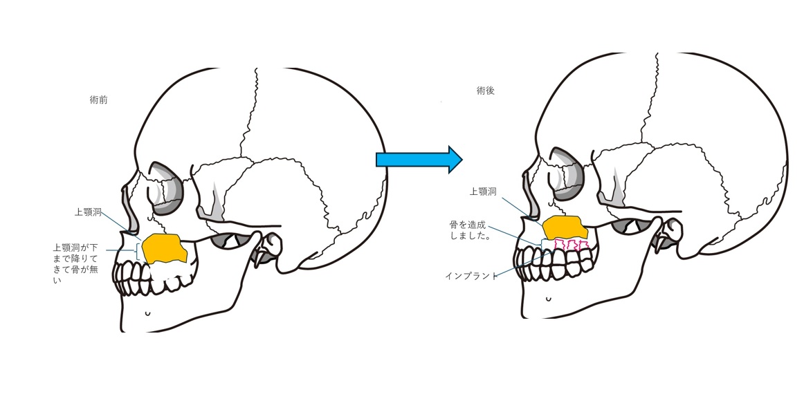 鹿児島　歯医者　インプラント難症例