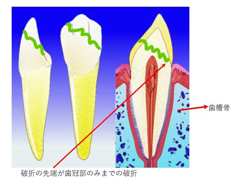 鹿児島 歯医者 歯の破折