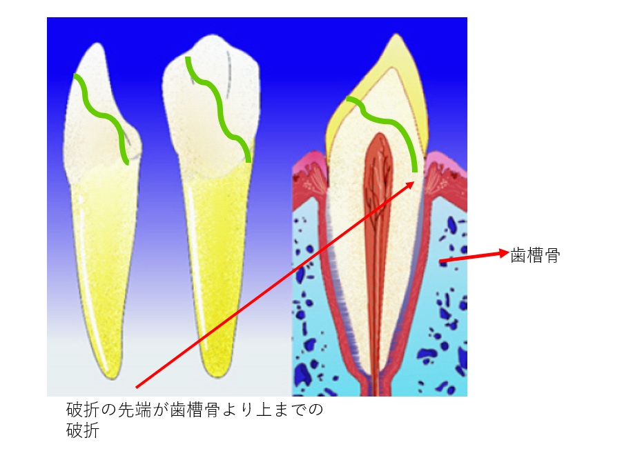 鹿児島 歯医者 歯の破折