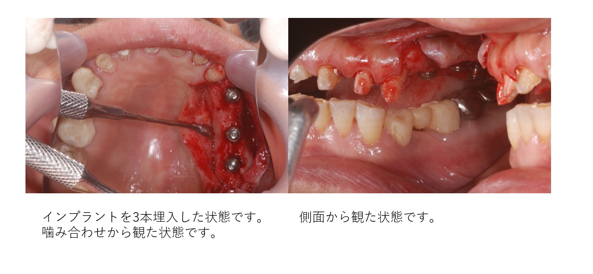 鹿児島　歯医者　インプラント難症例