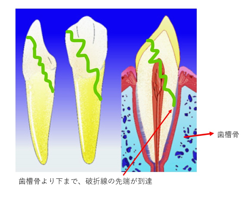 鹿児島 歯医者 歯の破折