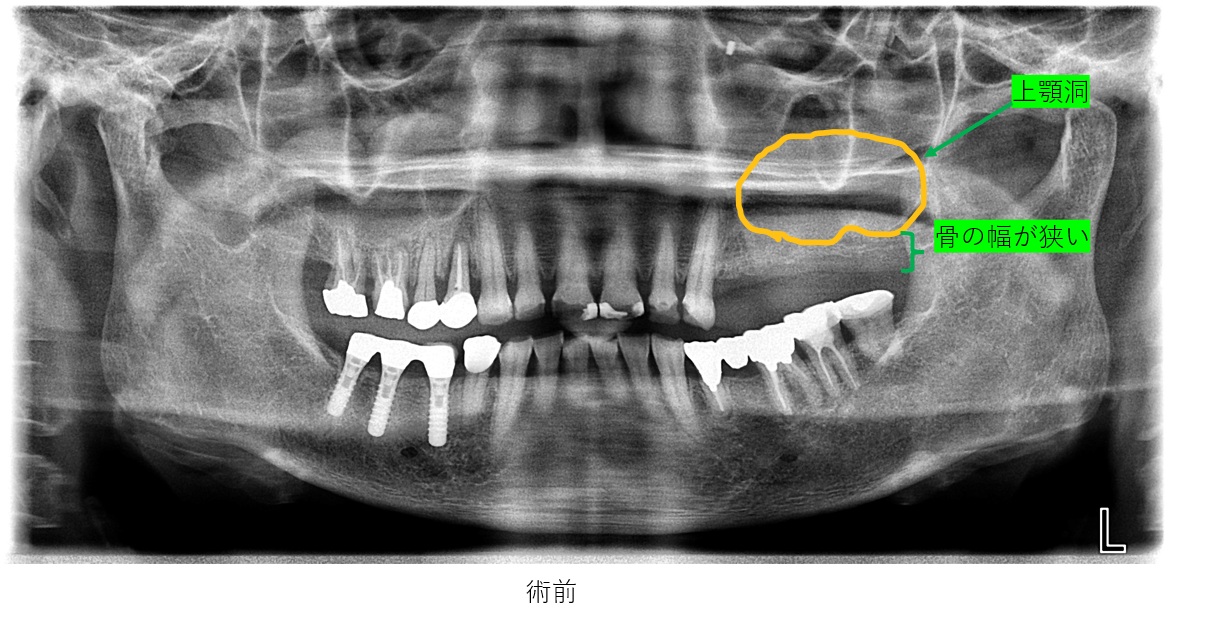 鹿児島　歯医者　インプラント難症例