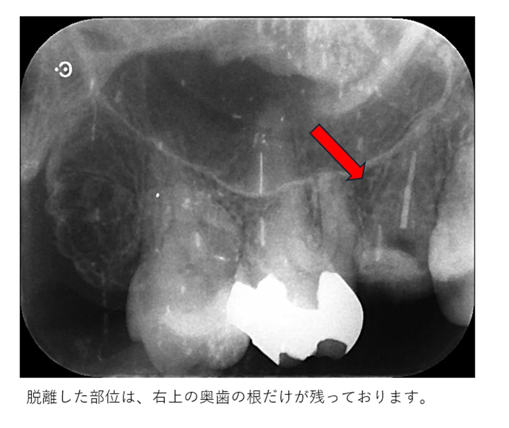 鹿児島 歯医者 レントゲン 破折