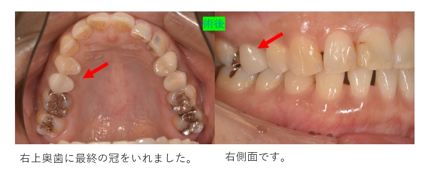 鹿児島 歯医者 歯の破折
