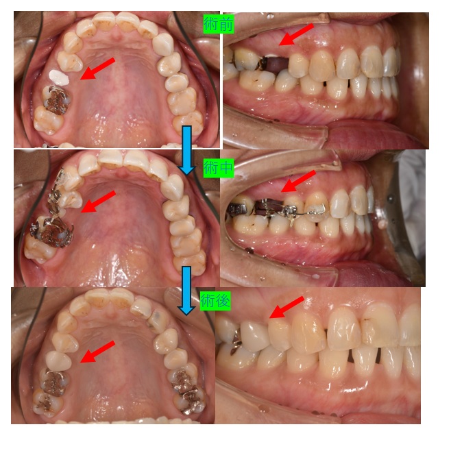 鹿児島 歯医者 歯の破折