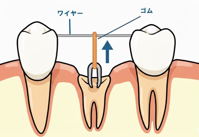 鹿児島 歯医者 歯の破折