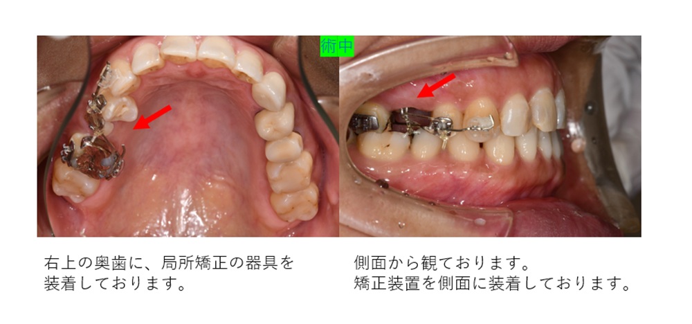 鹿児島 歯医者 歯の破折 エクスルージョン方法