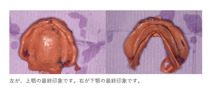 鹿児島　歯医者　シリコン印象最終