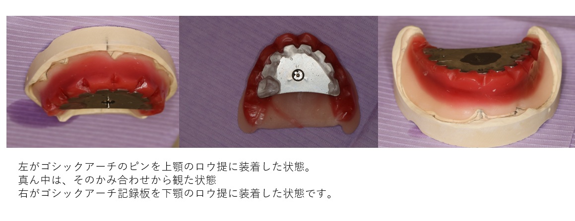 鹿児島　歯医者　義歯