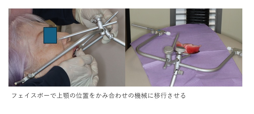 鹿児島　歯医者　義歯