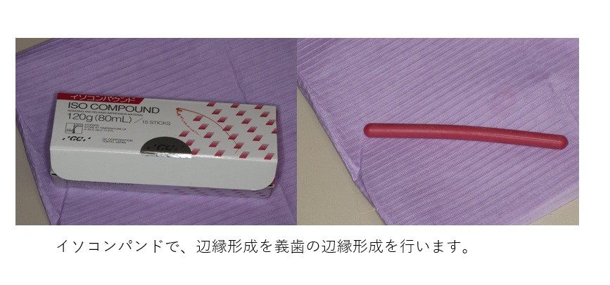 鹿児島　歯医者　義歯