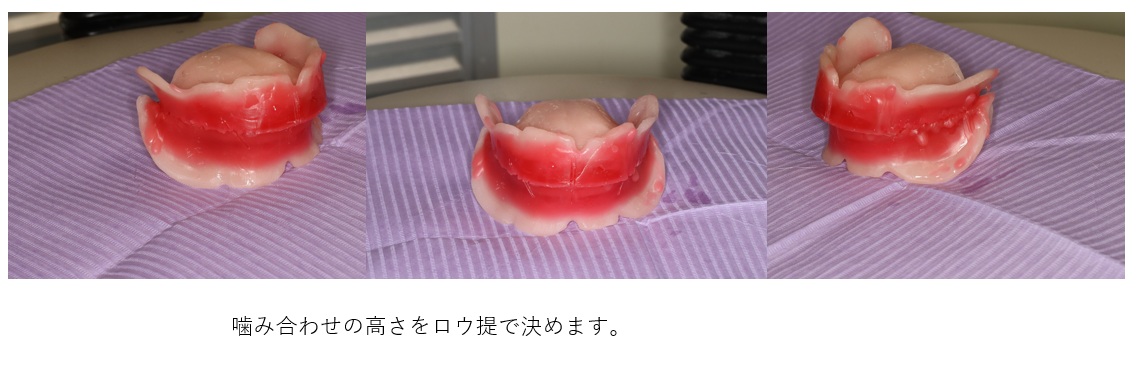 鹿児島　歯医者　義歯