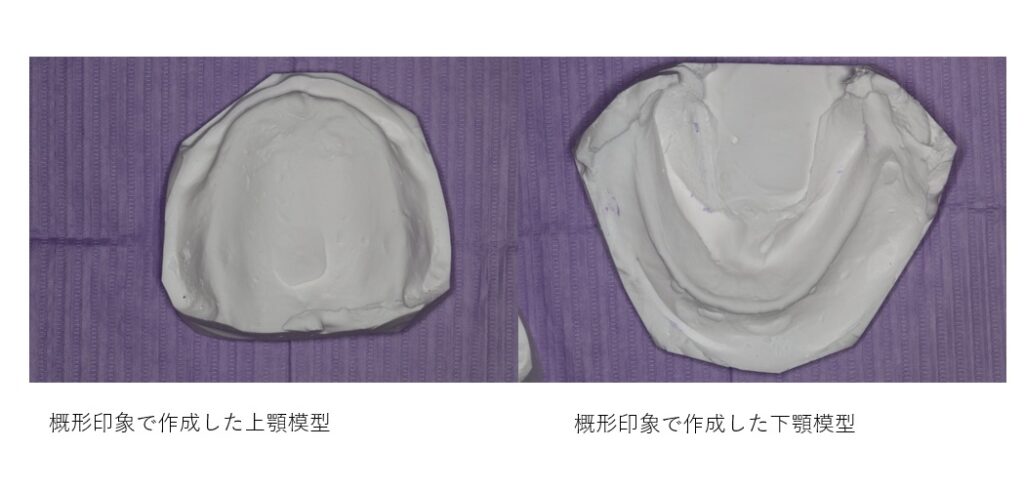 鹿児島　歯医者　義歯