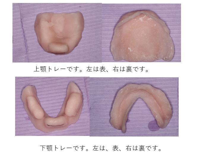 鹿児島　歯医者　義歯