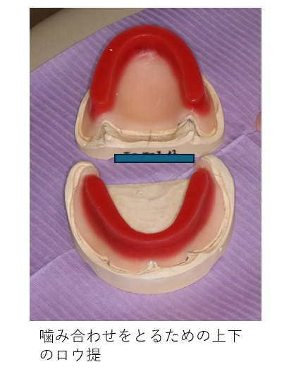 鹿児島　歯医者　義歯